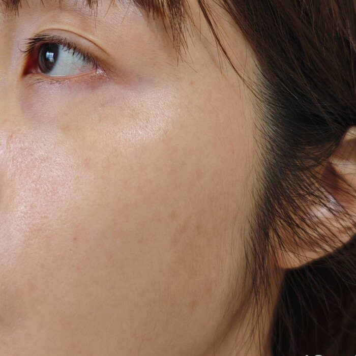 EVOXOME 外泌體精華液使用前照片