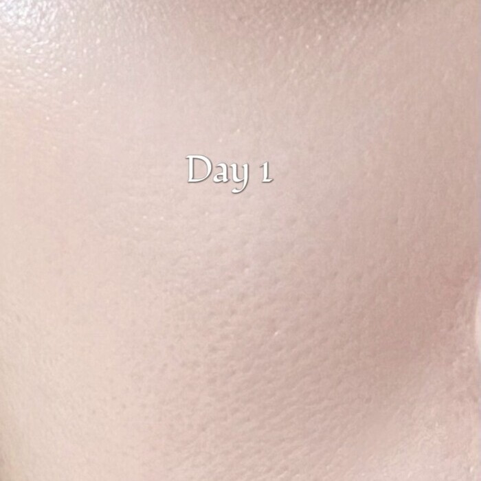 EVOXOME 外泌體精華液使用前照片-Day01