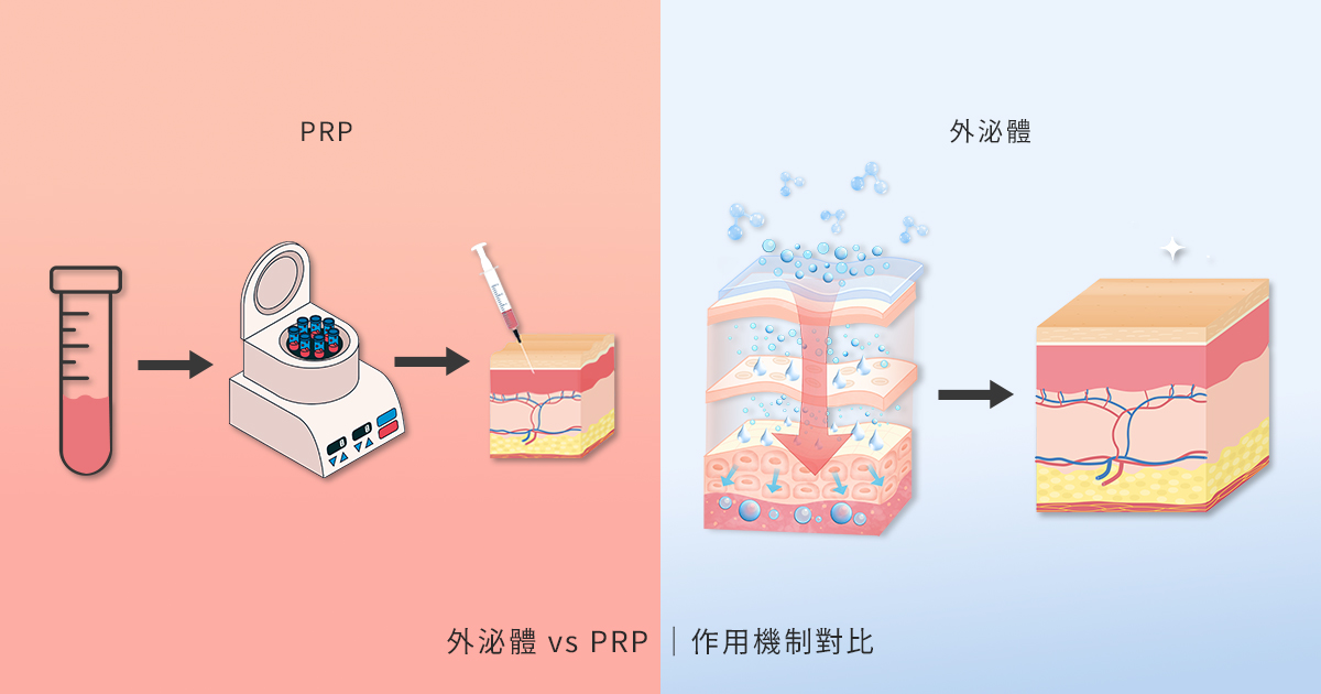 外泌體 vs PRP 比較概念圖